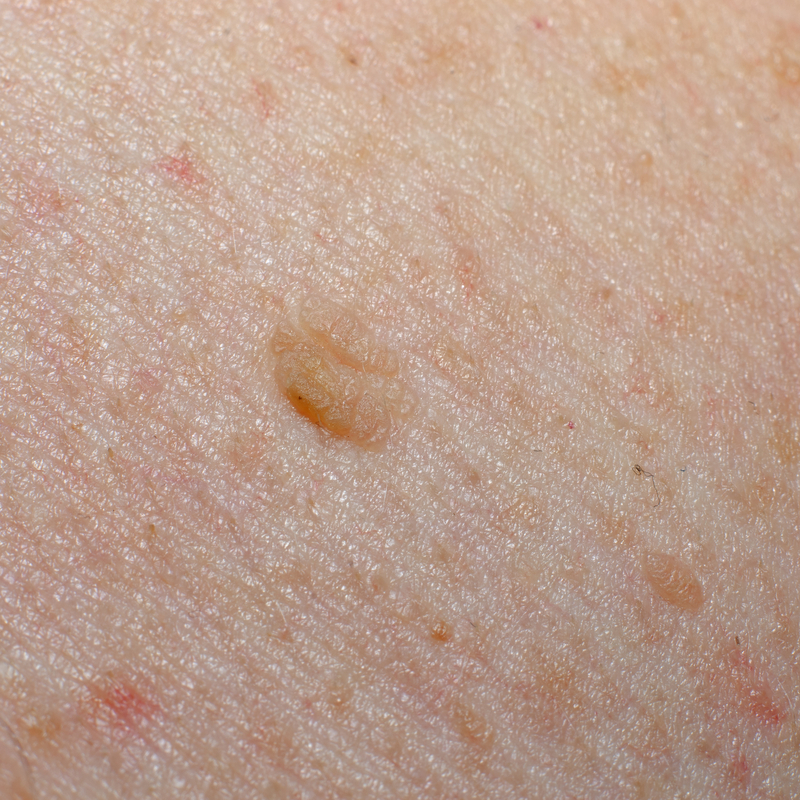 En dybdegående kig på keratosis pilaris